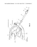 METHOD AND APPARATUS FOR REPAIRING A MITRAL VALVE diagram and image