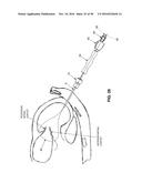 METHOD AND APPARATUS FOR REPAIRING A MITRAL VALVE diagram and image