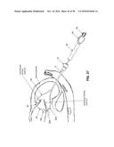 METHOD AND APPARATUS FOR REPAIRING A MITRAL VALVE diagram and image