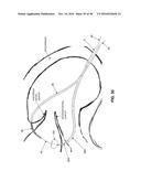 METHOD AND APPARATUS FOR REPAIRING A MITRAL VALVE diagram and image