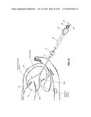 METHOD AND APPARATUS FOR REPAIRING A MITRAL VALVE diagram and image