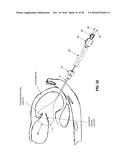 METHOD AND APPARATUS FOR REPAIRING A MITRAL VALVE diagram and image