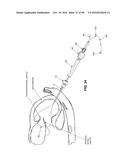 METHOD AND APPARATUS FOR REPAIRING A MITRAL VALVE diagram and image