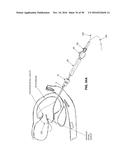 METHOD AND APPARATUS FOR REPAIRING A MITRAL VALVE diagram and image