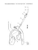 METHOD AND APPARATUS FOR REPAIRING A MITRAL VALVE diagram and image