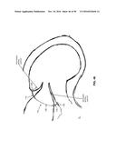 METHOD AND APPARATUS FOR REPAIRING A MITRAL VALVE diagram and image