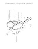 METHOD AND APPARATUS FOR REPAIRING A MITRAL VALVE diagram and image