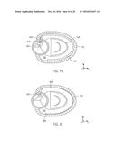 METHOD AND APPARATUS FOR CATHETER-BASED ANNULOPLASTY USING LOCAL     PLICATIONS diagram and image