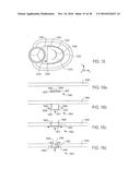 METHOD AND APPARATUS FOR CATHETER-BASED ANNULOPLASTY USING LOCAL     PLICATIONS diagram and image