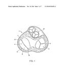 METHOD FOR STABILIZING A CARDIAC VALVE ANNULUS diagram and image