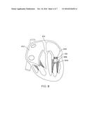 METHOD FOR STABILIZING A CARDIAC VALVE ANNULUS diagram and image