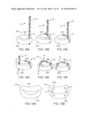 SYSTEM FOR MITRAL VALVE REPAIR AND REPLACEMENT diagram and image