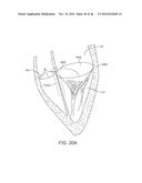 SYSTEM FOR MITRAL VALVE REPAIR AND REPLACEMENT diagram and image