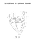 SYSTEM FOR MITRAL VALVE REPAIR AND REPLACEMENT diagram and image