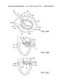 SYSTEM FOR MITRAL VALVE REPAIR AND REPLACEMENT diagram and image