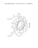 SYSTEM FOR MITRAL VALVE REPAIR AND REPLACEMENT diagram and image