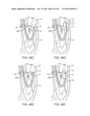 SYSTEM FOR MITRAL VALVE REPAIR AND REPLACEMENT diagram and image