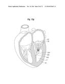 APPARATUS FOR TREATING A HEART VALVE diagram and image