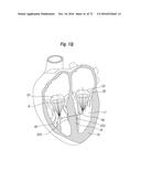 APPARATUS FOR TREATING A HEART VALVE diagram and image