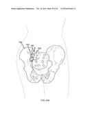 METHODS OF FUSING A SACROILIAC JOINT diagram and image