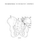 METHODS OF FUSING A SACROILIAC JOINT diagram and image