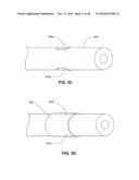 LOW PROFILE ELECTRODES FOR AN ANGIOPLASTY SHOCK WAVE CATHETER diagram and image