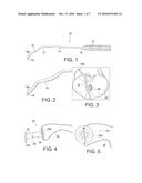 METHODS AND INSTRUMENTS FOR FORMING A POSTERIOR KNEE PORTAL AND FOR     INSERTING A CANNULA diagram and image