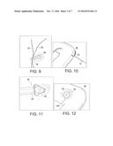 METHODS AND INSTRUMENTS FOR FORMING A POSTERIOR KNEE PORTAL AND FOR     INSERTING A CANNULA diagram and image