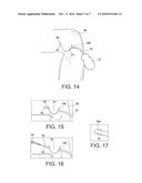 METHODS AND INSTRUMENTS FOR FORMING A POSTERIOR KNEE PORTAL AND FOR     INSERTING A CANNULA diagram and image