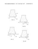 Revision Systems, Tools and Methods for Revising Joint Arthroplasty     Implants diagram and image