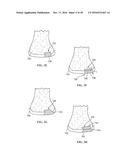 Revision Systems, Tools and Methods for Revising Joint Arthroplasty     Implants diagram and image