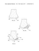 Revision Systems, Tools and Methods for Revising Joint Arthroplasty     Implants diagram and image