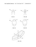 Revision Systems, Tools and Methods for Revising Joint Arthroplasty     Implants diagram and image