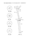 Revision Systems, Tools and Methods for Revising Joint Arthroplasty     Implants diagram and image