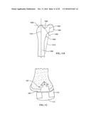 Revision Systems, Tools and Methods for Revising Joint Arthroplasty     Implants diagram and image