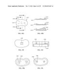 Revision Systems, Tools and Methods for Revising Joint Arthroplasty     Implants diagram and image