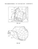 Revision Systems, Tools and Methods for Revising Joint Arthroplasty     Implants diagram and image