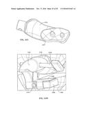 Revision Systems, Tools and Methods for Revising Joint Arthroplasty     Implants diagram and image