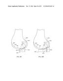 Revision Systems, Tools and Methods for Revising Joint Arthroplasty     Implants diagram and image