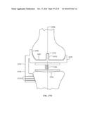 Revision Systems, Tools and Methods for Revising Joint Arthroplasty     Implants diagram and image