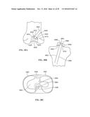 Revision Systems, Tools and Methods for Revising Joint Arthroplasty     Implants diagram and image