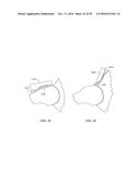 Revision Systems, Tools and Methods for Revising Joint Arthroplasty     Implants diagram and image