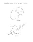 Revision Systems, Tools and Methods for Revising Joint Arthroplasty     Implants diagram and image
