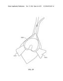 Revision Systems, Tools and Methods for Revising Joint Arthroplasty     Implants diagram and image