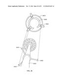 Revision Systems, Tools and Methods for Revising Joint Arthroplasty     Implants diagram and image