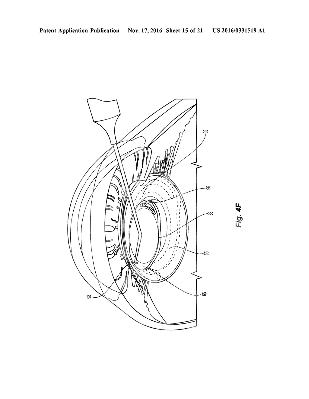 MODULAR INTRAOCULAR LENS DESIGNS, TOOLS AND METHODS - diagram, schematic, and image 16