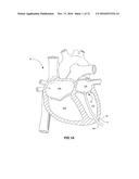 PERCUTANEOUS TRANSCATHETER REPAIR OF HEART VALVES VIA TRANS-APICAL ACCESS diagram and image