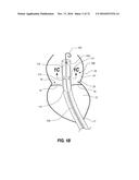 PERCUTANEOUS TRANSCATHETER REPAIR OF HEART VALVES VIA TRANS-APICAL ACCESS diagram and image