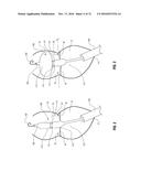 PERCUTANEOUS TRANSCATHETER REPAIR OF HEART VALVES VIA TRANS-APICAL ACCESS diagram and image