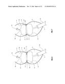 PERCUTANEOUS TRANSCATHETER REPAIR OF HEART VALVES VIA TRANS-APICAL ACCESS diagram and image